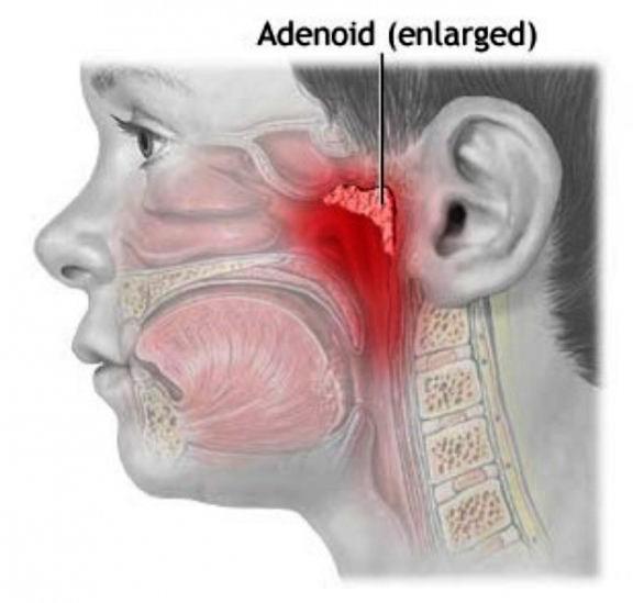 adenoidy