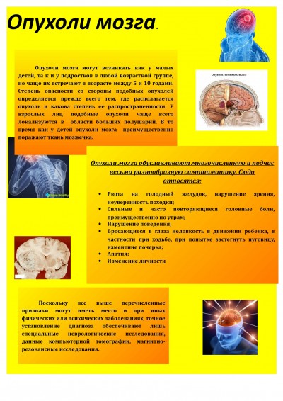 Опухоли мозга