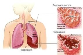 Blog | Как лечится пневмония?